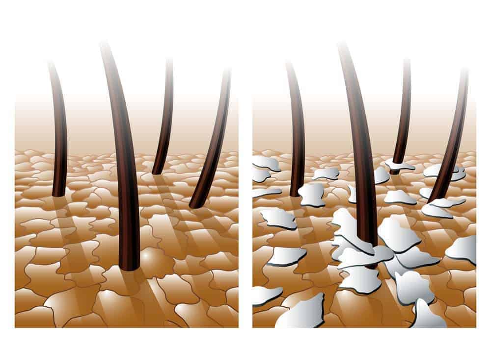 Dandruff vs. Dry Scalp: Understanding the Differences - And How Xtrallux Plays a Role