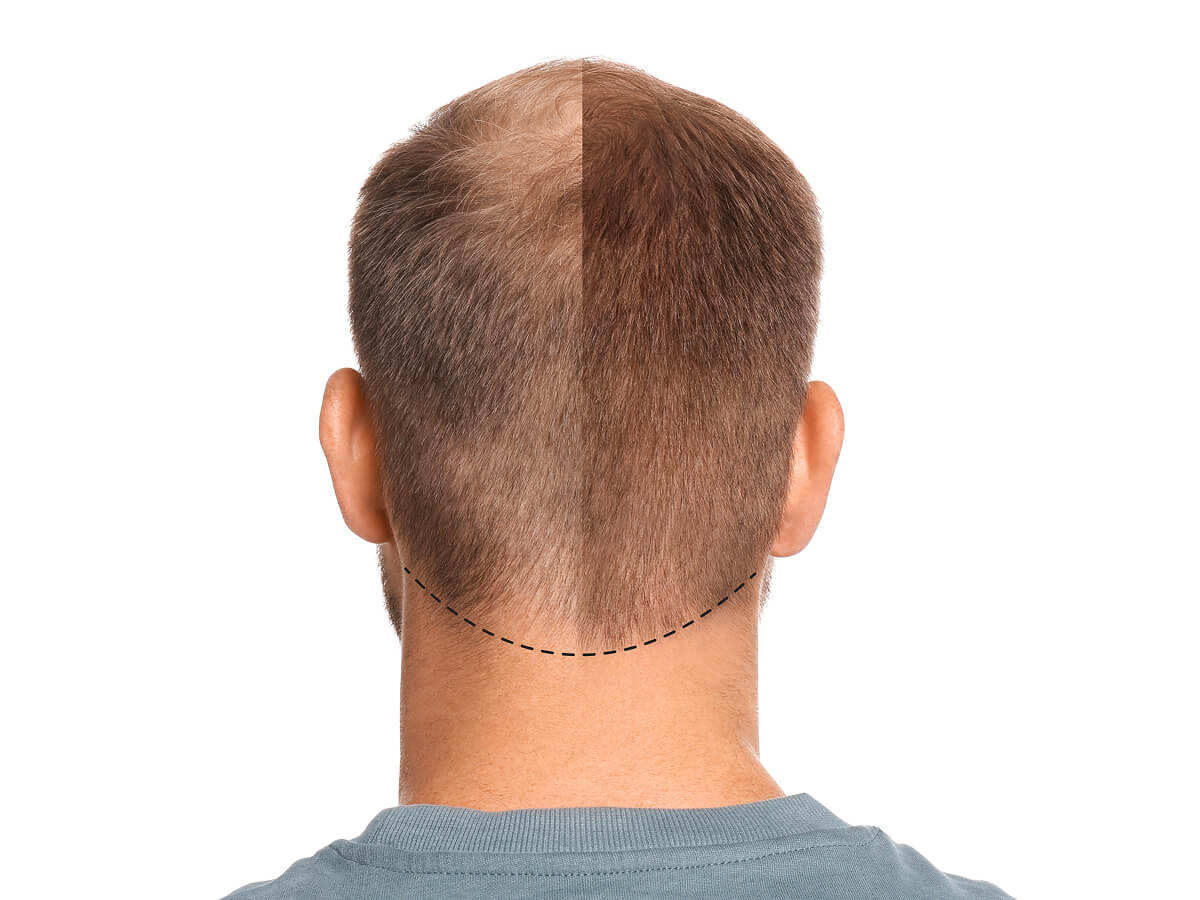 Telogen Effluvium vs Balding: How to Tell the Difference