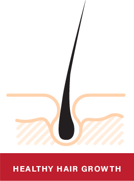What Happens to Hair Treated with Laser Therapy?