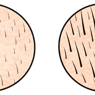 Androgenetic Alopecia, Hair Miniaturization & Laser Therapy