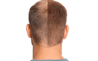 Telogen Effluvium vs Balding: How to Tell the Difference