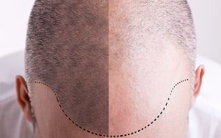 Mature Hairline vs. Balding: Understanding the Differences - And How Xtrallux Can Assist