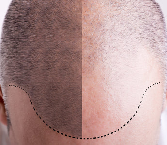 Mature Hairline vs. Balding: Understanding the Differences - And How Xtrallux Can Assist