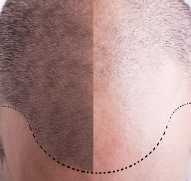 Mature Hairline vs. Balding: Understanding the Differences - And How Xtrallux Can Assist