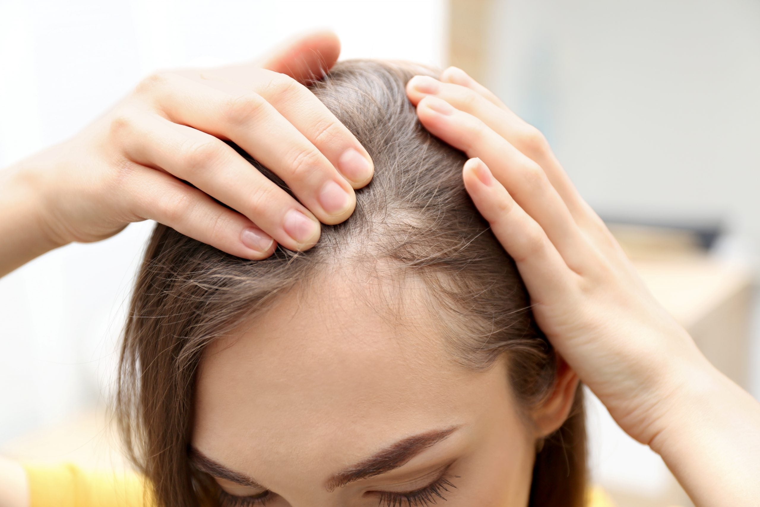 Understanding the Ludwig Scale: Navigating Through Female Pattern Hair Loss