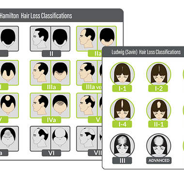 Hair Loss Patterns in Androgenetic Alopecia.png