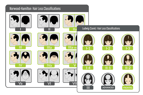 Hair Loss Patterns in Androgenetic Alopecia.png