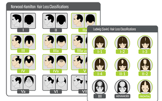 Hair Loss Patterns in Androgenetic Alopecia.png