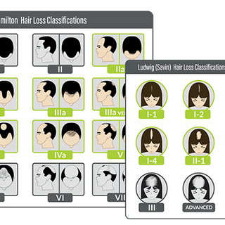 Hair Loss Patterns in Androgenetic Alopecia.png