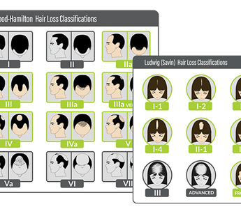 Hair Loss Patterns in Androgenetic Alopecia.png
