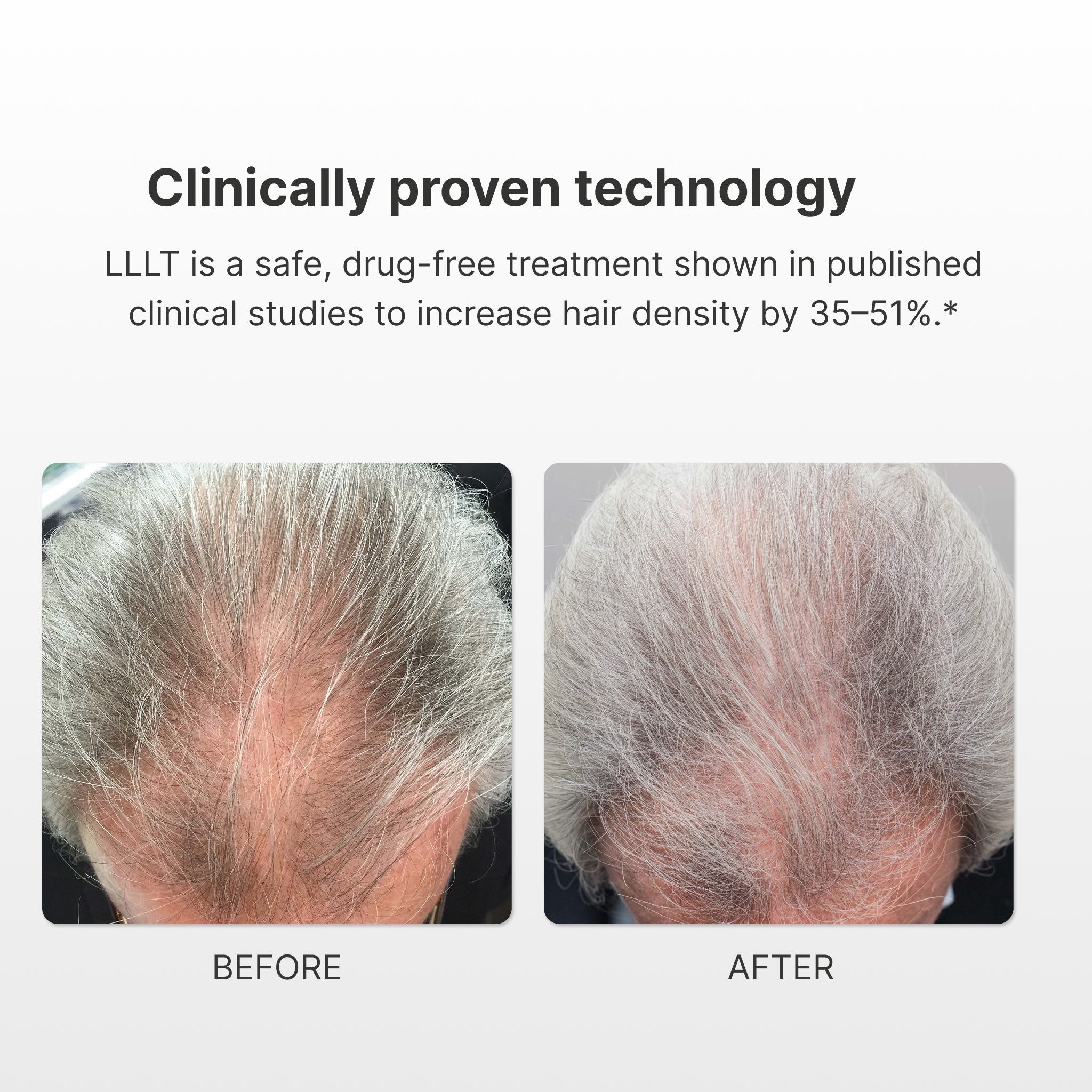 Xtrallux SuperPlus (276) Hair Regrowth Laser Cap